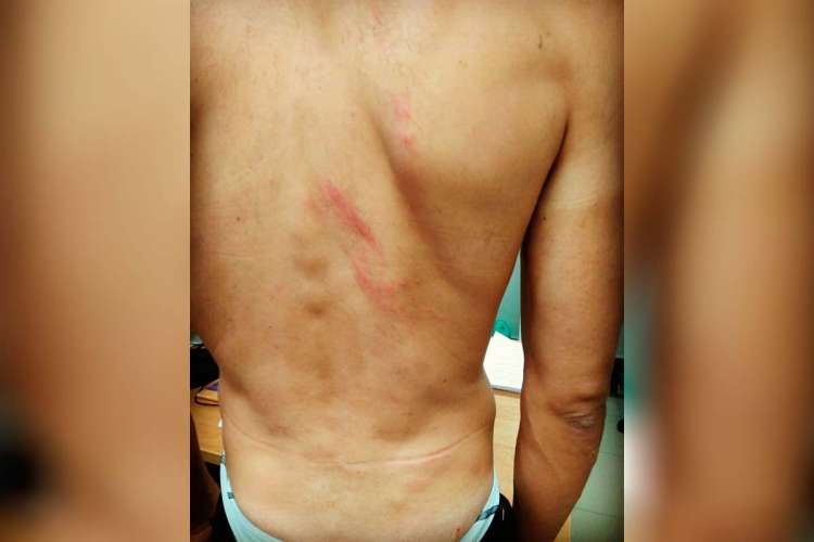 Lesiones ocasionadas en la espalda de Alberto Bejarano